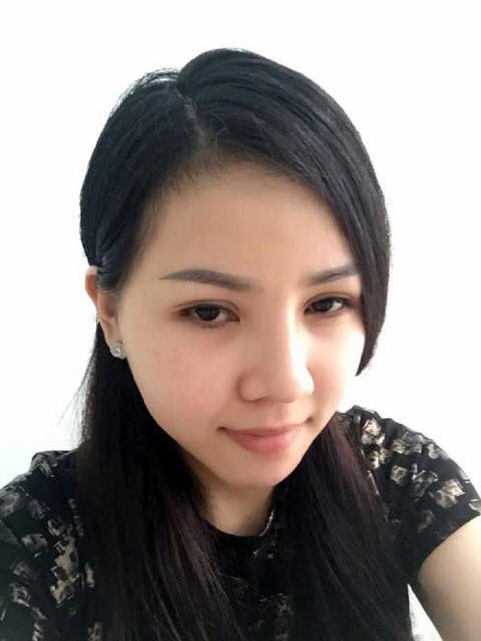 Nâng mũi Hàn Quốc