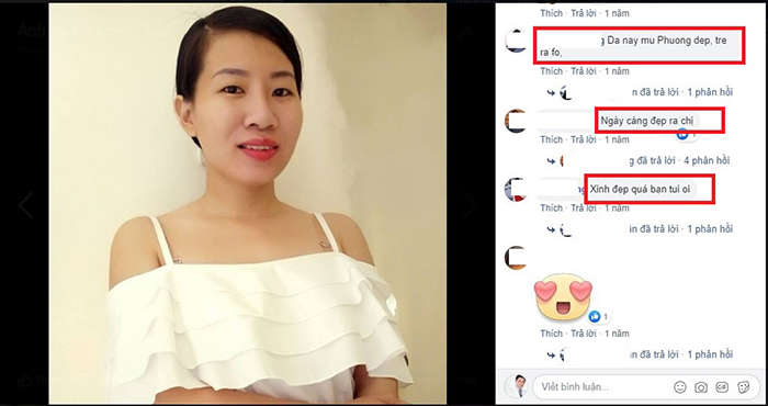 Nâng mũi Hàn Quốc