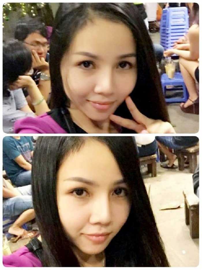 Nâng mũi Hàn Quốc