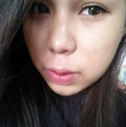 Bấm mí Hàn Quốc