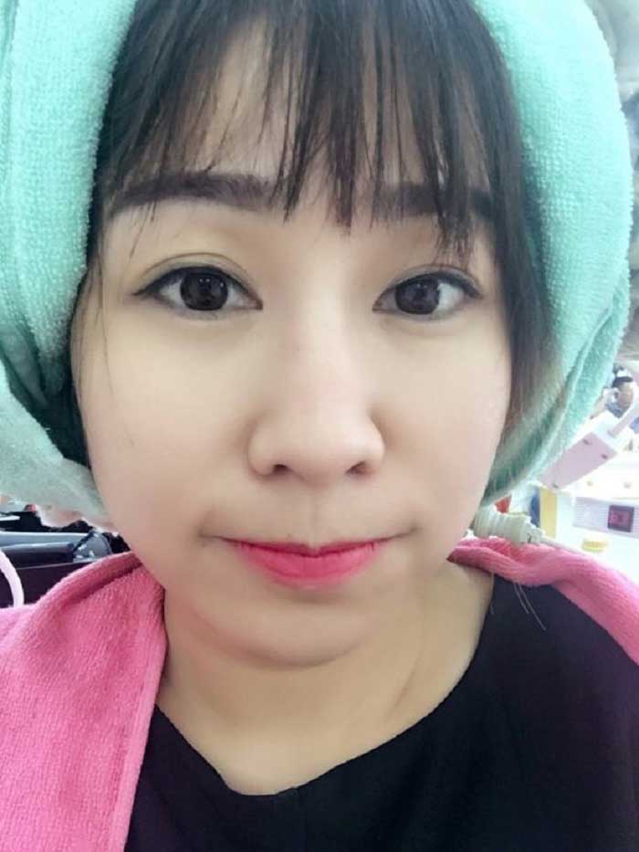 Cắt mí mắt