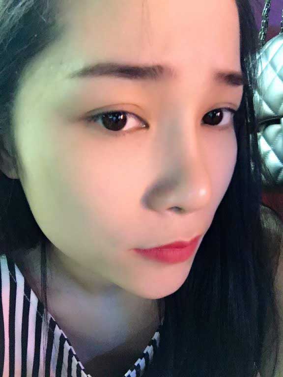 Độn cằm