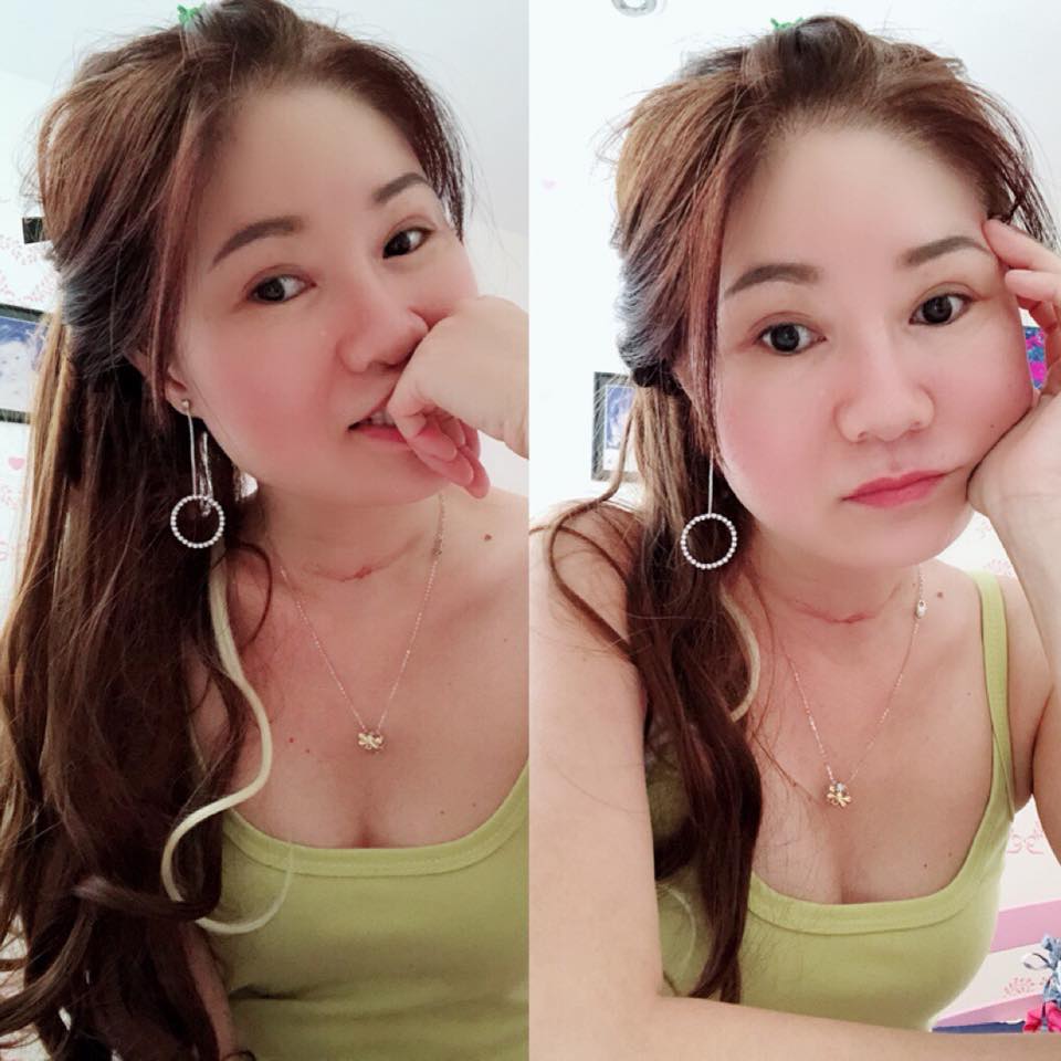 Mở rộng góc mắt