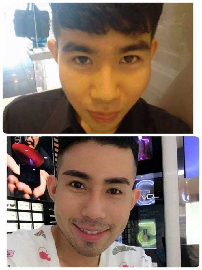 Lấy mỡ má