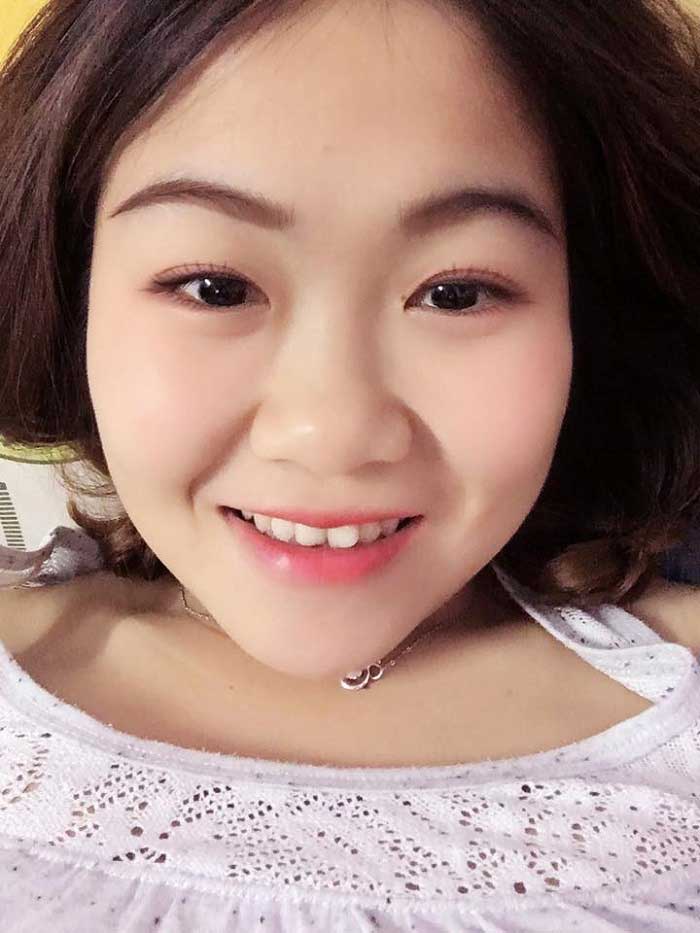 Nâng mũi bọc sụn