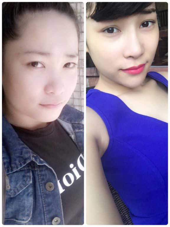 Độn cằm