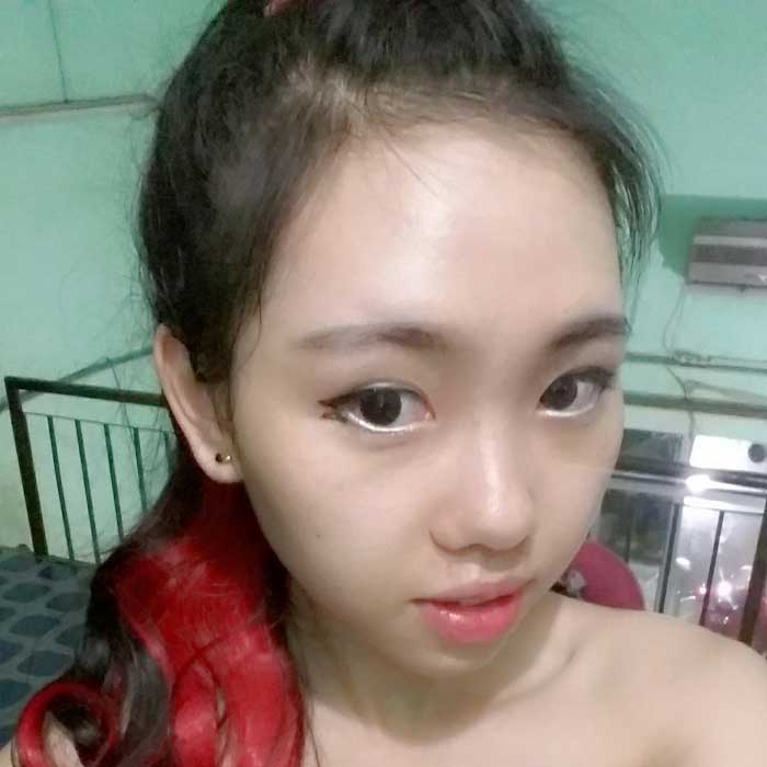 Nâng mũi bọc sụn