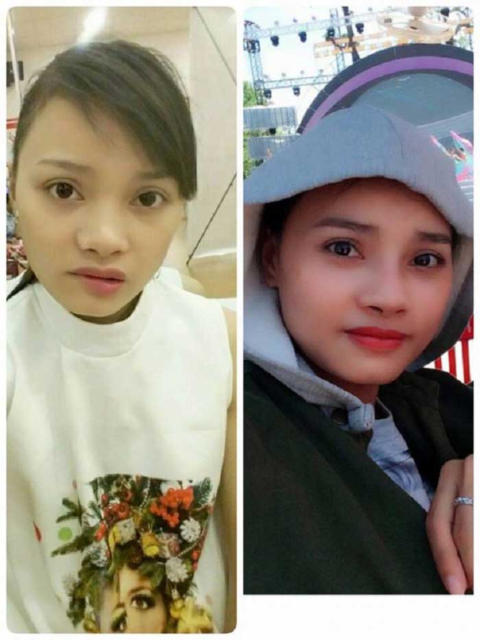 Nâng mũi bọc sụn