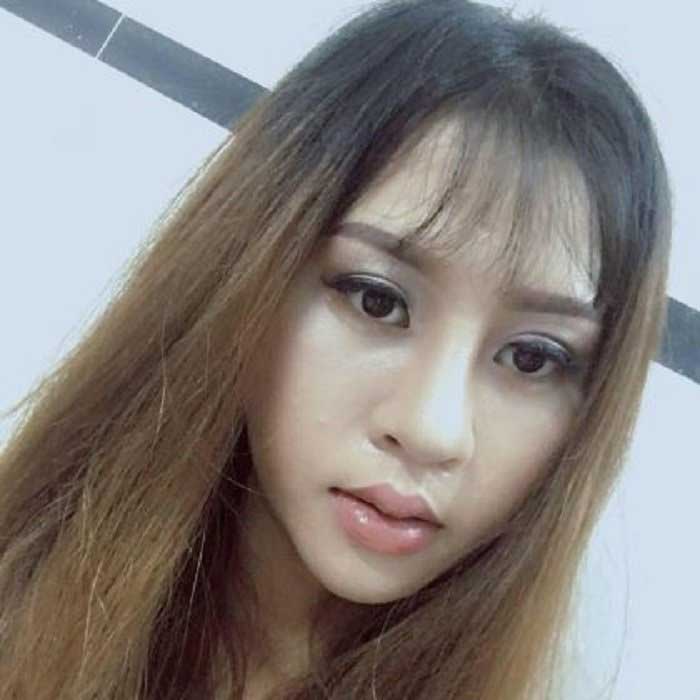 Nâng mũi bọc sụn