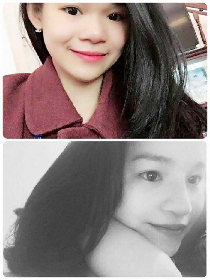 Nâng mũi bọc sụn