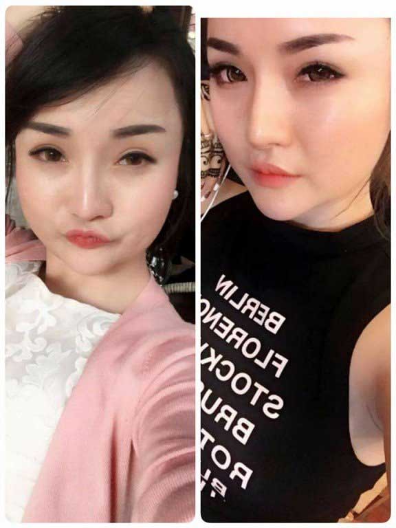 Độn cằm