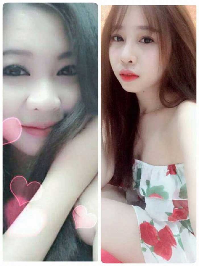 Nâng mũi bọc sụn