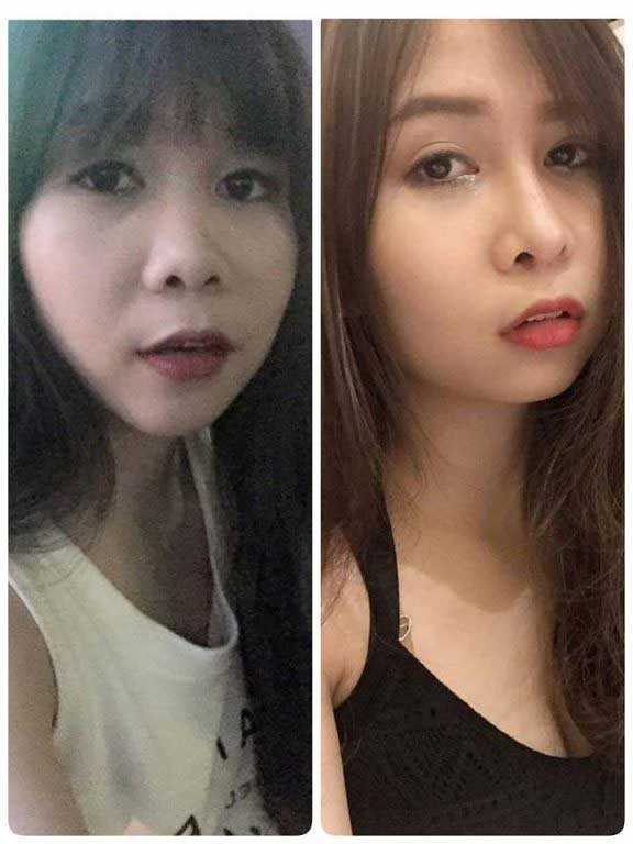 Nâng mũi S Line