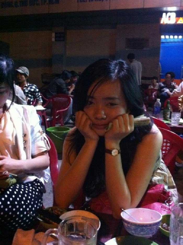 Nâng mũi bọc sụn