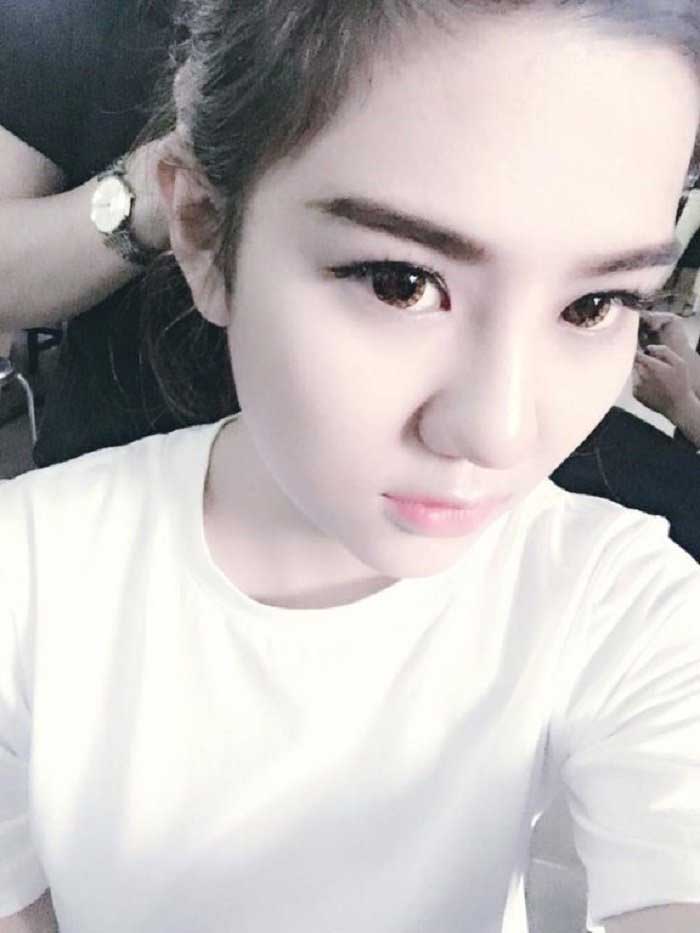 Nâng mũi bọc sụn