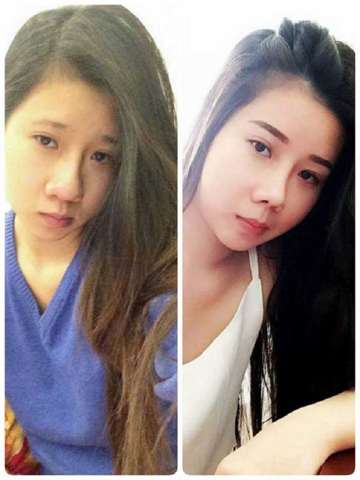 Nâng mũi bọc sụn