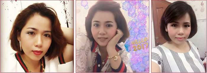 Cắt mí mắt