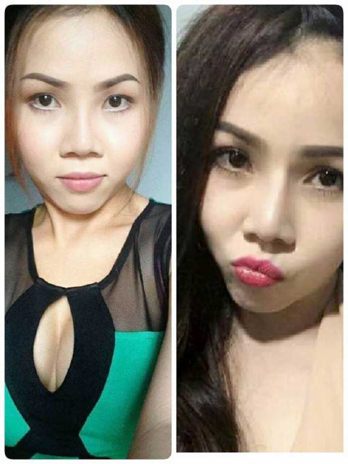 Nâng mũi Hàn Quốc