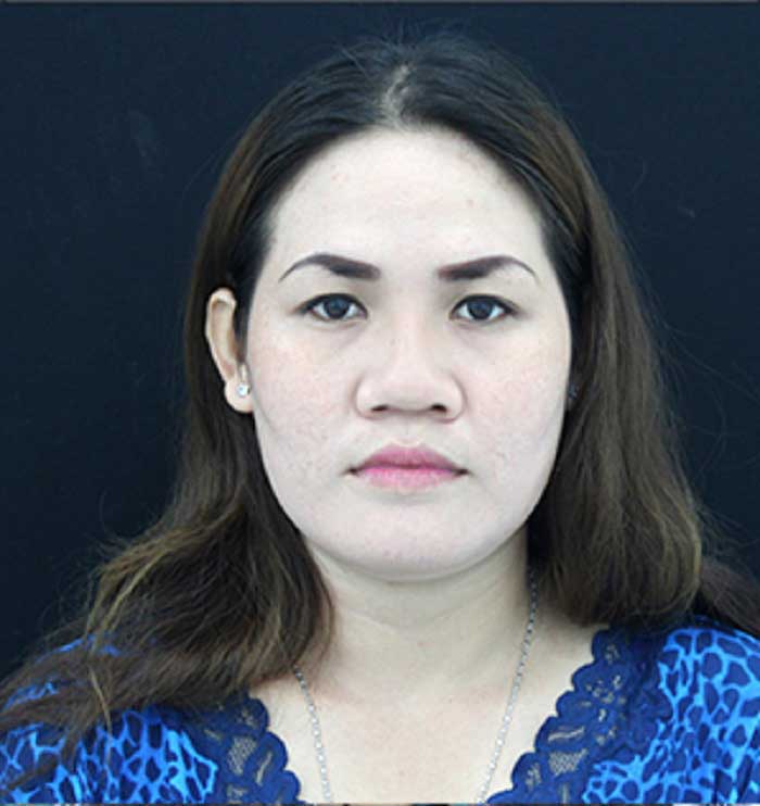 Nâng mũi bọc sụn