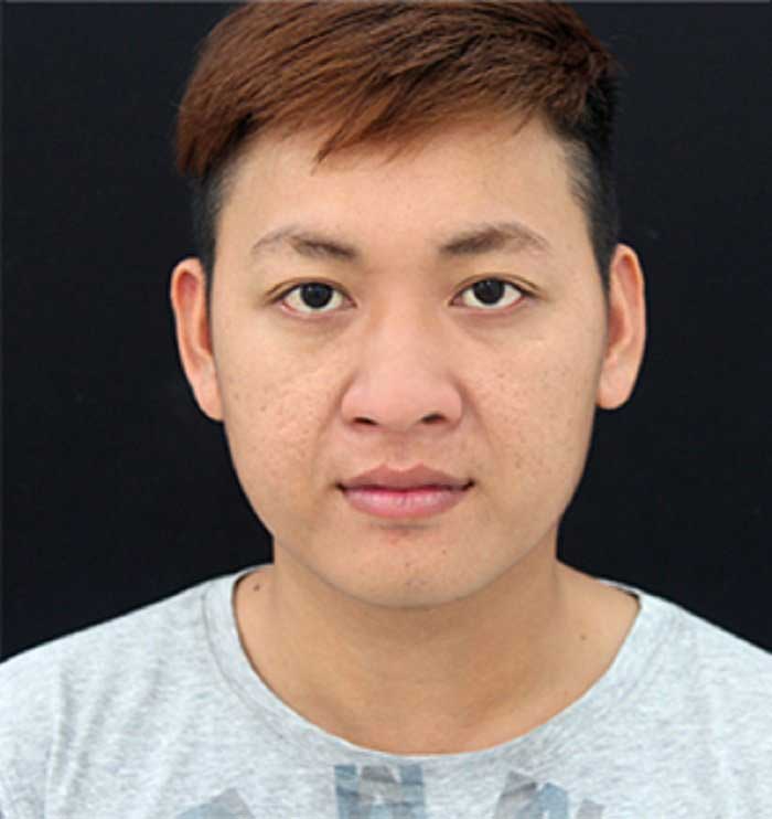 Nâng mũi bọc sụn