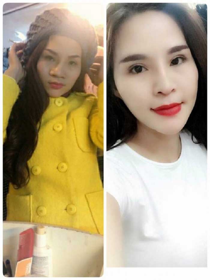 Nâng mũi Hàn Quốc
