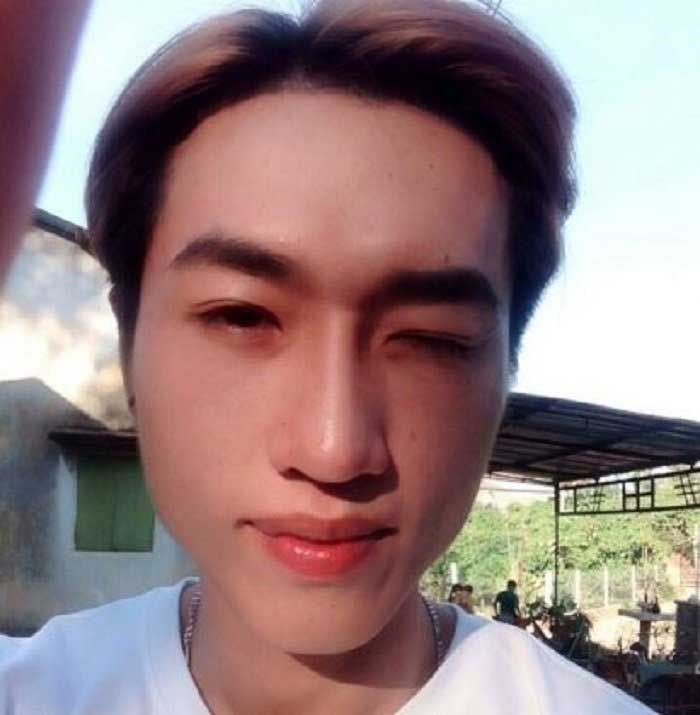 Cắt mí mắt