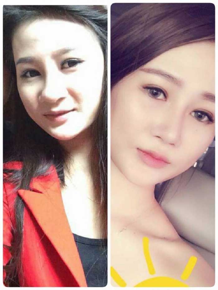 Nâng mũi Hàn Quốc