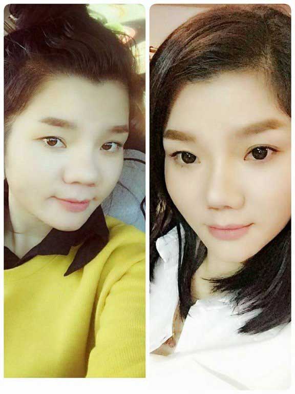 Thu gọn cánh mũi