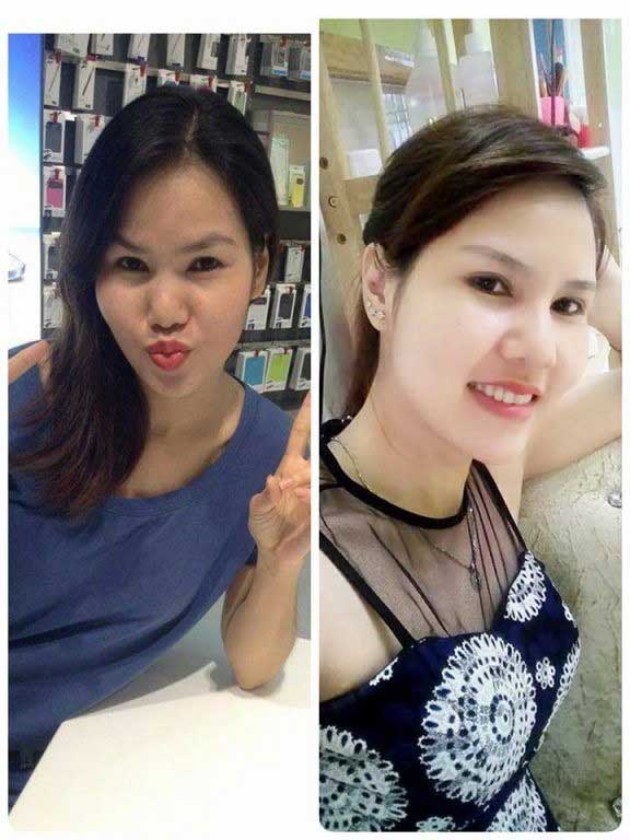 Bấm mí Hàn Quốc