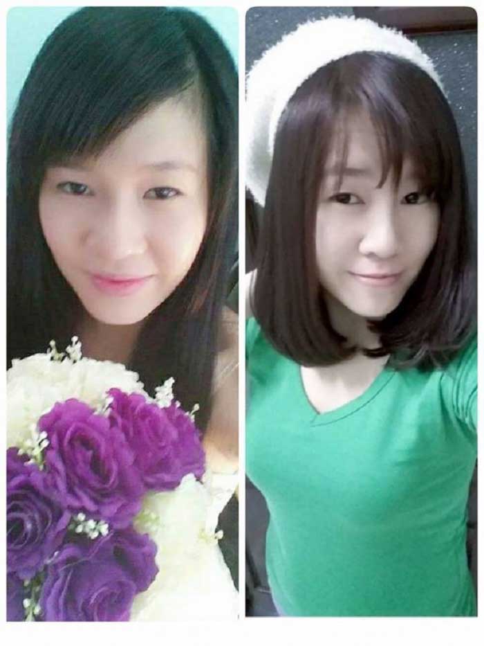 Nâng mũi bọc sụn
