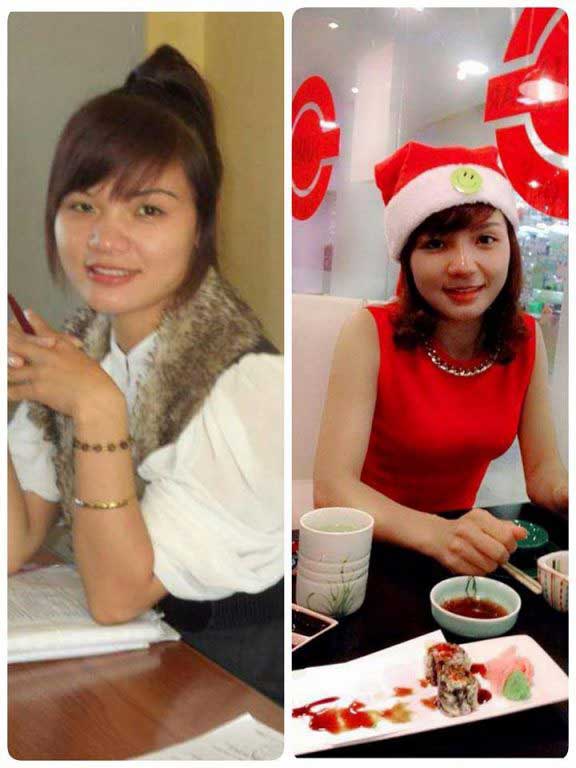 Gọt cằm