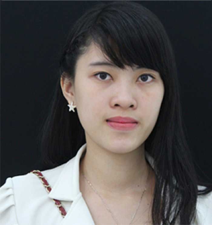 Nâng mũi bọc sụn