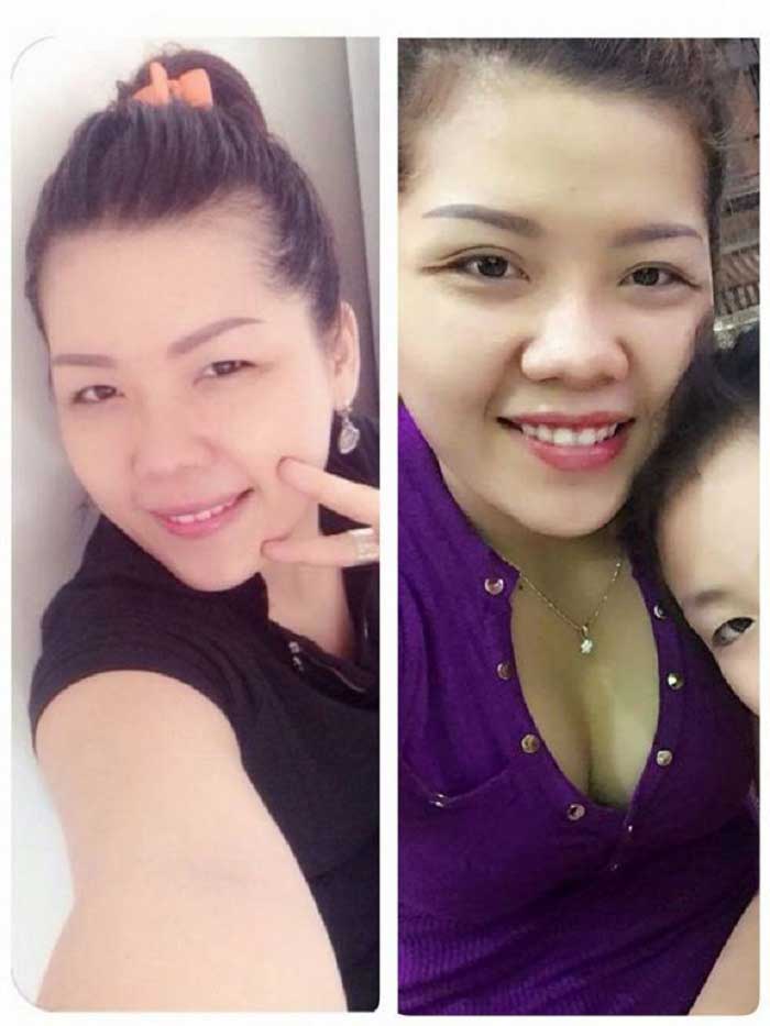 Cắt mí mắt