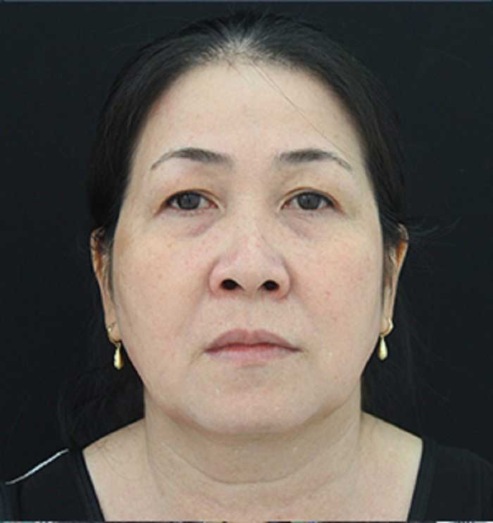 Cắt mí mắt