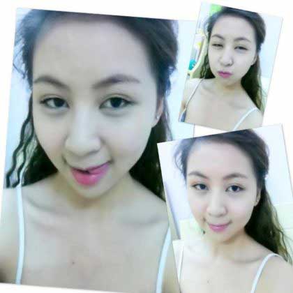 Độn cằm