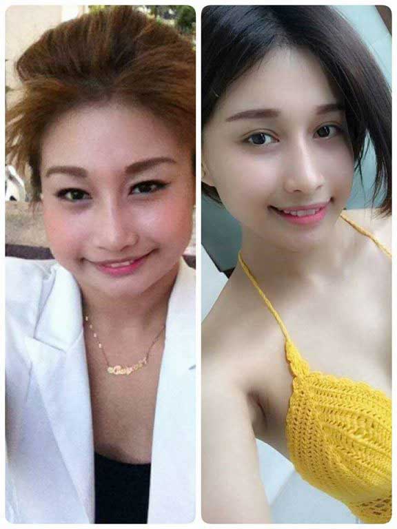 Độn cằm Độn cằm
