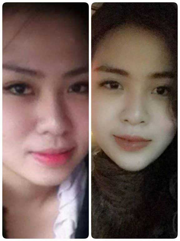 Độn cằm