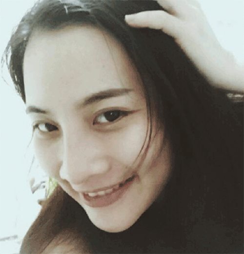 Nâng mũi bọc sụn