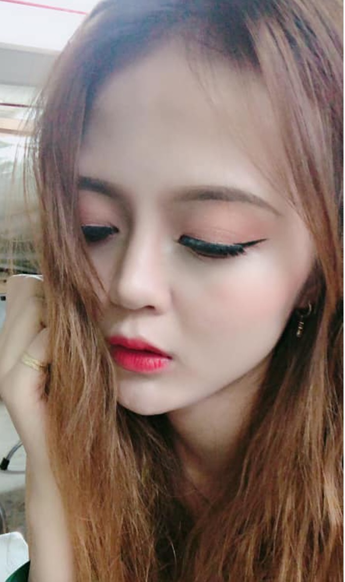 Nâng mũi bọc sụn