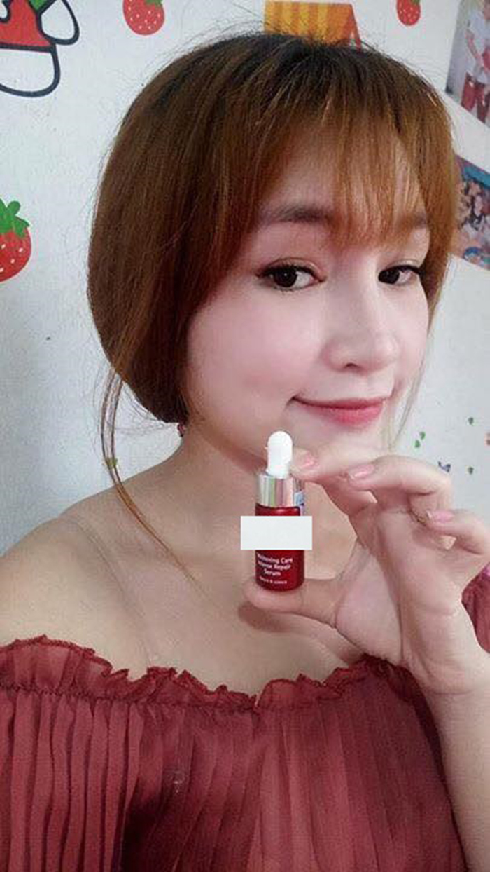 Nâng mũi bọc sụn