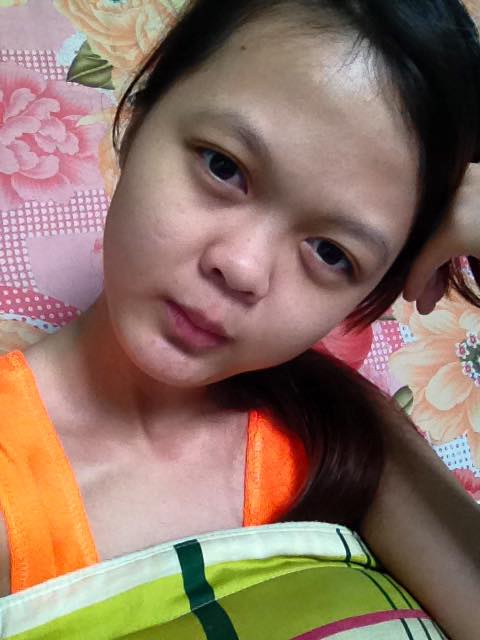 Nâng mũi bọc sụn