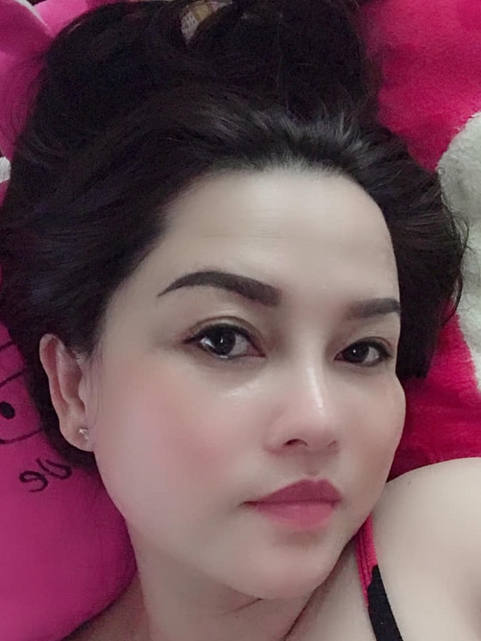 Nâng mũi bọc sụn