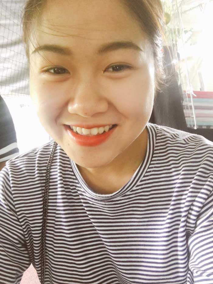 Nâng mũi bọc sụn