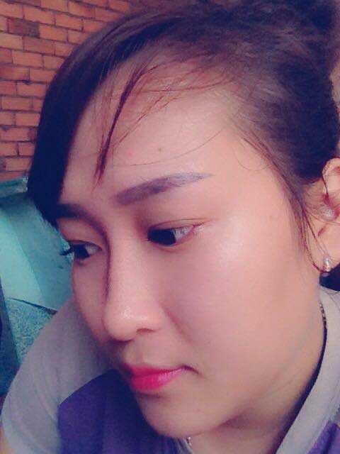 Cắt mí mắt