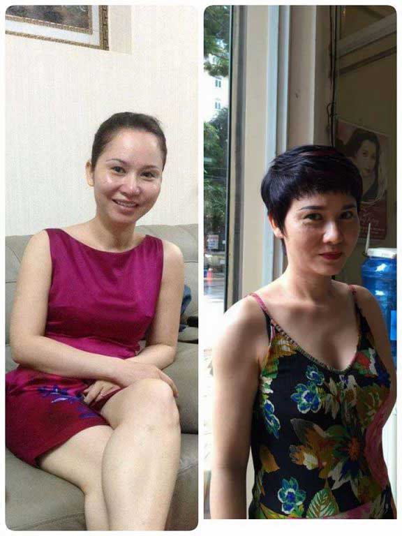 Độn cằm