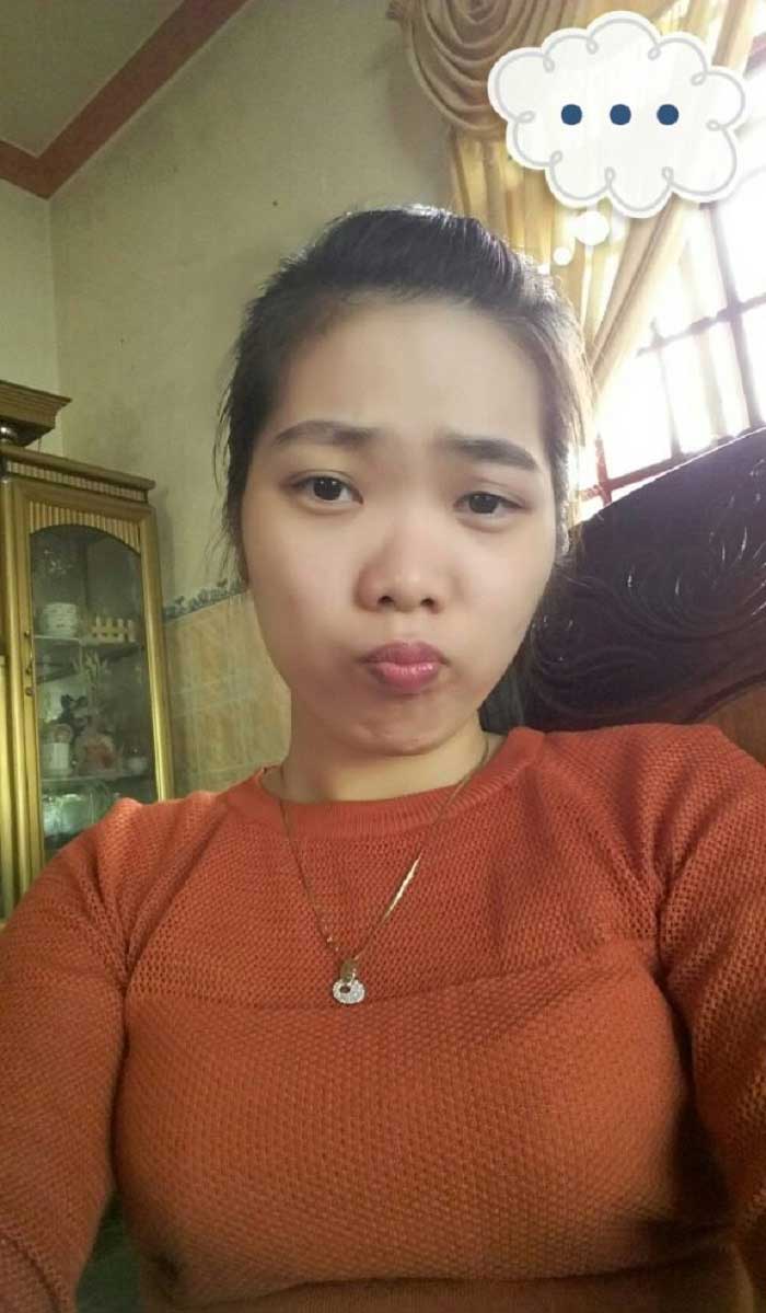 Nâng mũi bọc sụn