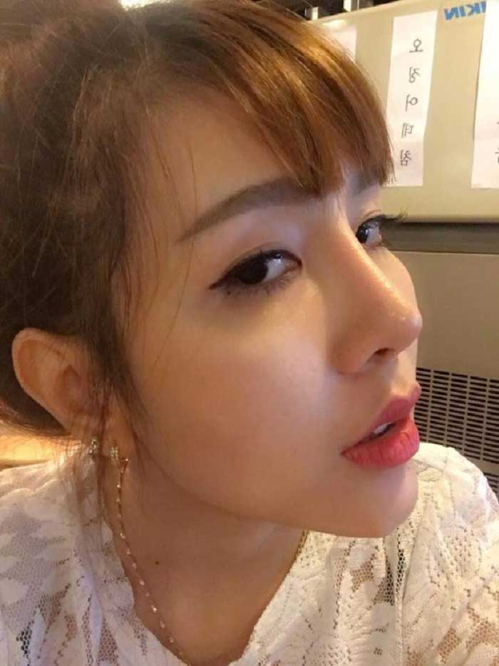 Nâng mũi Hàn Quốc