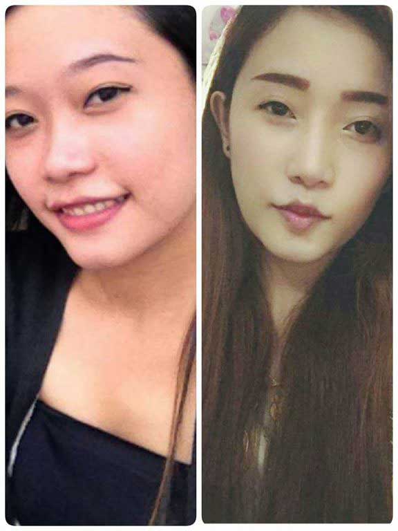 Nâng mũi S Line
