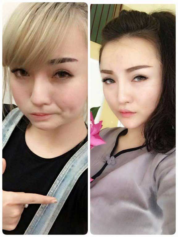 Độn cằm