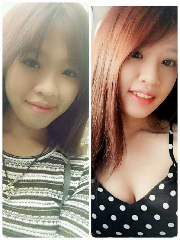 Nâng mũi bọc sụn